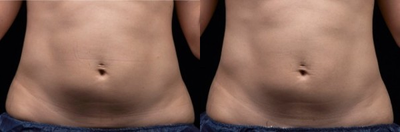 Liposonix - 
	Liposonix
