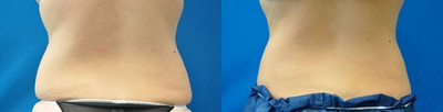 Liposonix - 
	Liposonix

