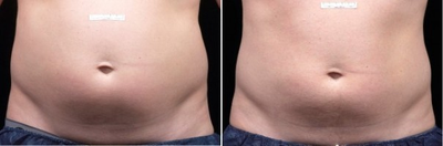Liposonix - 
	Liposonix
