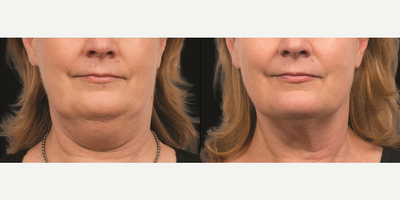 Woman treated with Skin Tightening - Woman treated with Skin Tightening