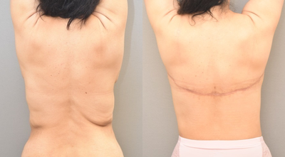 47 year old woman treated with Back Lift - 47 year old woman treated with Back Lift