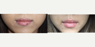 Q-switched laser treatment for the removal of lip spots, Los Angeles - Patient is a 25ish female Asian patient and was concerned about a very visible mole or sun spot at her left lower lip. One treatment later with our Palomar Qyag V laser and her lips are a perfectly clear and consistent color throughout!