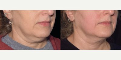 Woman treated with Emface - EMFACE Before & After Results The GNMS team is thrilled to bring new technology to you!