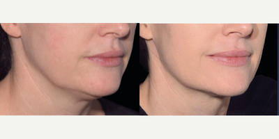 Woman treated with Emface - The new EMFACE now at GNMS! Non-surgical face and neck lift! No needles and only 4 treatments!
