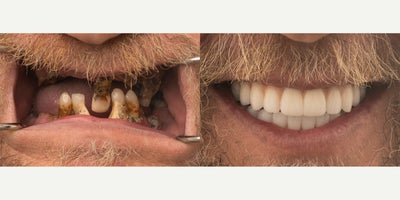 45-54 year old man treated with All-on-4 Dental Implants, Dental Implants - This patient came to us with only a handful of teeth remaining and was ready for a permanent solution. After a full arch dental implant treatment, they now have a complete, functional smile that looks and feels natural. The transformation has been life-changing, both in appearance and everyday comfort.