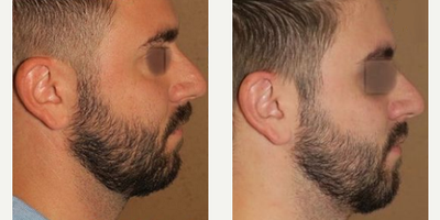 Man treated with Buccal Fat Removal - Man treated with Buccal Fat Removal