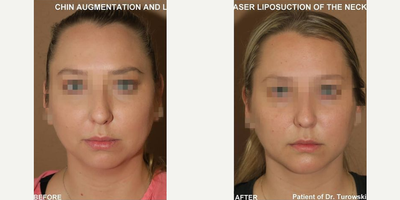 Woman treated with Chin Liposuction - Woman treated with Chin Liposuction