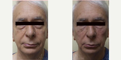 75 and up year old woman treated with Juvederm, Volbella, Voluma, Restylane, Restylane Contour - 4D Under Eye Lift - Treatment of dark circles & bags under eyes and cheek restoration with Belotero, Restylane, Volbella and Voluma