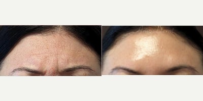 35-44 year old woman treated with Botox, Dysport - Treatment of lines and wrinkles in forehead, glabella & frown lines (with Botox, Jeuveau, Dysport, Daxxify or Xeomin)