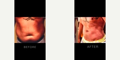 25-34 year old man treated with Abdominal Etching, Liposuction - 25-34 year old man treated with Abdominal Etching, Liposuction