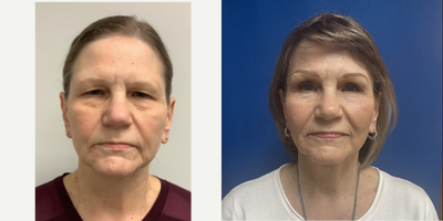 65-74 year old woman treated with Double Eyelid Surgery, CO2 Laser - 65-74 year old woman treated with Double Eyelid Surgery, CO2 Laser.
