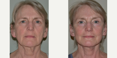 55-64 year old woman treated with Brow Lift, Earlobe Repair - 55-64 year old woman treated with Brow Lift, Earlobe Repair- 18 months post-op