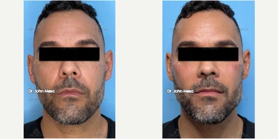35-44 year old man treated with Facial Masculinization with Fillers ( Cheekbone Fillers, Chin Fillers, Jaw Fillers) - 35-44 year old man treated with Facial Masculinization with Fillers ( Cheekbone Fillers, Chin Fillers, Jaw Fillers)