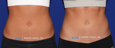 25-34 year old woman treated with Emsculpt - 27 year old woman before and after 6 sessions of Emsculpt to her abs