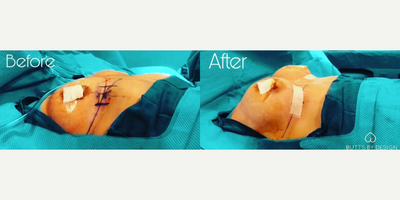 Woman treated with Breast Augmentation - Woman treated with Breast Augmentation