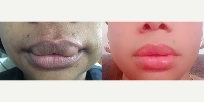 25-34 year old woman treated with Lip Reduction - Upper lip reduction after ilegal silicone injections a couple of years ago, removing must of this haloplastic material in a single procedure using and absorbable suture an inofficeprocedure with local anesthesia.