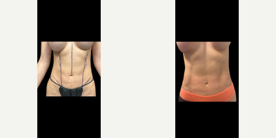 35-44 year old woman treated with Abdominal Etching, Liposuction, Butt Augmentation, Butt Implants - Patient underwent liposuction to etch her abdomen. Patient also had a gluteal augmentation using 330cc textured, round implants.
