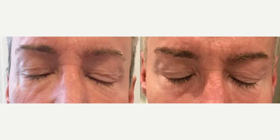 Man treated with ULTRAcel - Man treated with ULTRAcel