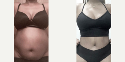 Woman treated with Tummy Tuck - Woman treated with Tummy Tuck