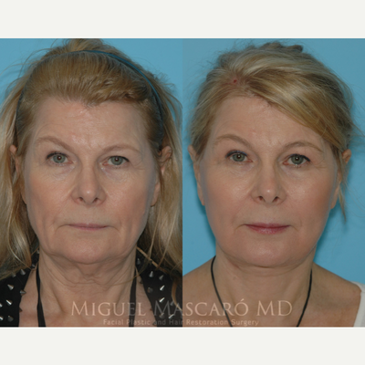 55-64 year old woman treated with Facelift - Patient 2 months after a face and neck lift with fat transfer and blepharoplsty