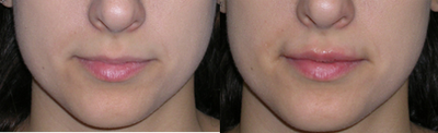 Juvederm - 39 year old female desired an upper lip augmentation. Shown before and immediately after injection of .8cc Juvederm Ultra into her upper lip.