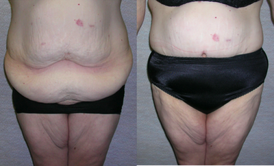 Body Lift - The patient had a 80 pound weight loss by having a gastric bypass completed. She received an extended abdominoplasty by making the incision around her waist.