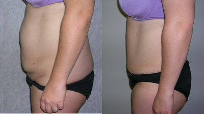 Tummy Tuck - 38 year old female, 5'3' and 150 lbs. six months after an abdominoplasty (tummy tuck) using the extended C-section incision. She had removal of excess skin and fat with tightening of the muscle.