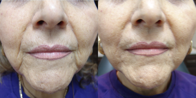 63 year old female treated with Juvederm to marionette lines - 63 year old female immediately after 1cc of Juvederm Vollure XC to marionette lines. This was a 30 minute procedure that was done in the Med Spa with topical anesthesia.