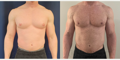 Man treated with Gynecomastia Surgery - Woman treated with Gynecomastia Surgery