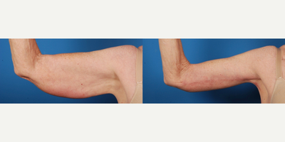45-54 year old woman treated with Arm Lift - 49 year old post weight loss with excess skin and fatty tissue. Brachioplasty and liposuction achieved her goals