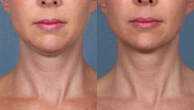 Woman treated with Kybella - Woman Treated with Kybella