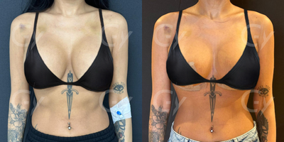 35-44 year old woman treated with Breast Implant Revision - Breast Implant Revision by M.D. Gray Yeiladal