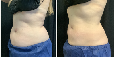 Woman treated with CoolSculpting Elite - Pre-Treatment vs Post-Treatment CoolSCulpting Elite. This patient had 2 rounds of CoolSculpting, 4 weeks apart.