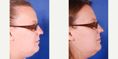 25-34 year old woman treated with endoscopic forehead Lipoma Removal - The forehead lipoma best visualized on the lateral views was removed via endoscopic surgery with small incisions placed behind the hairline.  This results in no visible scars.