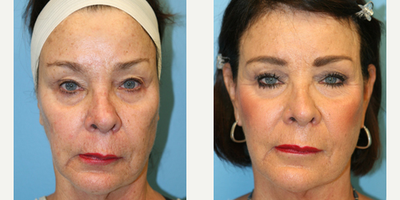 65 year old woman treated with Silhouette InstaLift - This patient was concerned with jowls forming. She had a Silhouette Instalift.