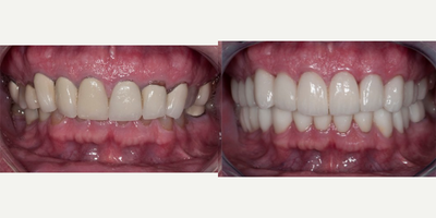 55-64 year old man treated with full mouth porcelain restorations - Patient was over closed vertically. Dr. Cha opened up patients bite and restored him with full mouth porcelain restorations