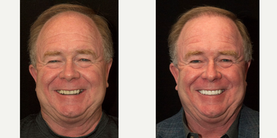 55-64 year old man treated with full mouth porcelain restorations - Patient was over closed vertically. Dr. Cha opened up patients bite and restored him with full mouth porcelain restorations