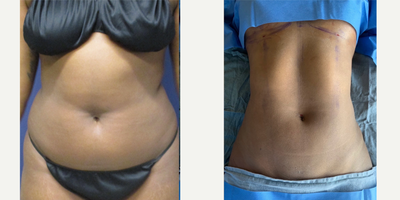 18-24 year old woman treated with Abdominal Etching - High Definition Liposuction of Upper and Lower Abdomen, Waist, Back Bra Rolls, Hips with Abdominal EtchingAge: 23yFHeight: 52Weight: 157 poundsBMI: 26Fat removed: 2000ccGoals: My goal is for you to literally sculpt me give me no waist and make my arch look more defined. I waist train for 6 hours/dy on top of working out and still am not at my body goalsTime after Surgery: Intraop