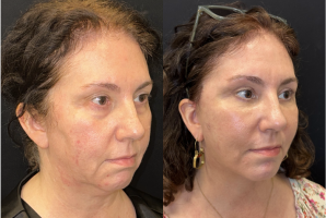 57 year old woman treated with CO2 Laser - 57 year old woman treated with CO2 Laser