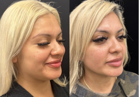 25-34 year old woman treated with Chin Liposuction - The patient is a 30 year oldfemale who is now 3 months s/p chin and neck liposculpting demonstrating crisp jawline and deep neck.