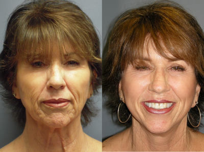 Obagi Blue Peel - 	This 65 year old had Obagi Blue Peel . The chemical peel applied after having a Lite Lift procedure maximizes the natural surgical results .