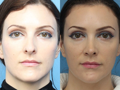 Woman treated with Rhinoplasty - Woman treated with Rhinoplasty