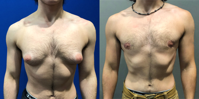18-24 year old woman treated with FTM Chest Masculinization Surgery - Peri-areolar bilateral mastectomy