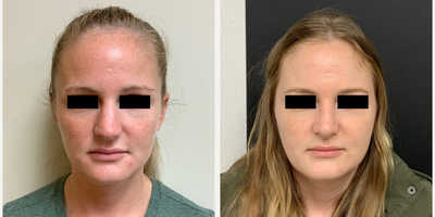 Rhinoplasty - Woman treated with Rhinoplasty