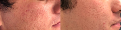 Man treated with Vivace - Man treated with Vivace