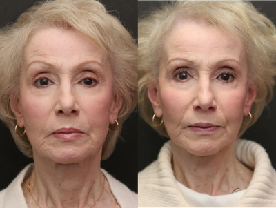 Cheek Implant - Cheek Implants and Minilift in a 77 year old