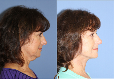 Neck Lift Performed Under Local Anesthesia  - This 63 year old, female patient was referred to Dr. Kevin Sadati by a friend of hers who had facelift surgery with him in the past. &nbsp;The patient's main concern was her turkey neck or lose jowls and extra skin around the neck area. Dr. Kevin Sadati, performed a neck lift under local anesthesia and twilight sedation without the need for general anesthesia. &nbsp;The entire surgery took about two hours. Recovery was minimally the patient returned to all normal activities within one week. &nbsp;