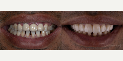25-34 year old man treated with Dental Crown - Here is a partial reset of an ongoing treatment. Patient initially approached us about being uncomfortable with his dental work completed years prior. They also insisted that we initiate treatment with the top teeth. After rehabilitating the bite with top dental restorations, patient is now undergoing Invisalign and will finalize treatment with bottom veneers.