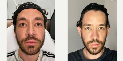 THE PERFECT PAIR | HALO AND PRP FOR THE WIN - Our patient was looking to get his acne scars on his cheeks and temples treated. He follows us on social media and was impressed by the litany great acne scar results we've achieved over the years. He also wanted to address some fine lines and texture issues as well as discoloration. He wants to feel more confident when hes out in public or taking selfies for IG and HALO can deliver on all of his concerns.  What makes HALO our patient-favorite treatment Hybrid fractional laser to improve quality of the skin with minimal downtime Improved skin tightening Acne scarring reduction Can be tailored for aggressive treatments on those with very significant wrinkles Long term collagen production Can be used all over the face and body including the neck, chest, arms, elbows and knees Combine with BBL HERO for enhanced outcomesTIP: ADD EMER SKINNo treatment is complete without EMER SKIN. Using our products post-treatment will enhance results to the absolute maximum. Click Link in Bio Click Emer Skin