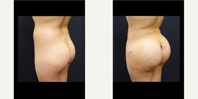 Butt Implants - Butt Implants
